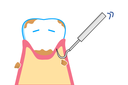 河内郡上三川・二階堂歯科医院・スケーリング